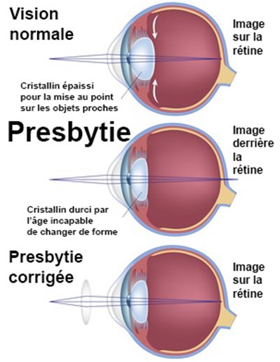 OPHTALMOLOGIE4