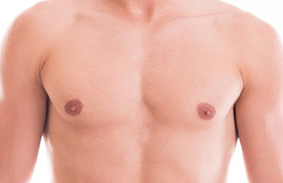 gynecomastie